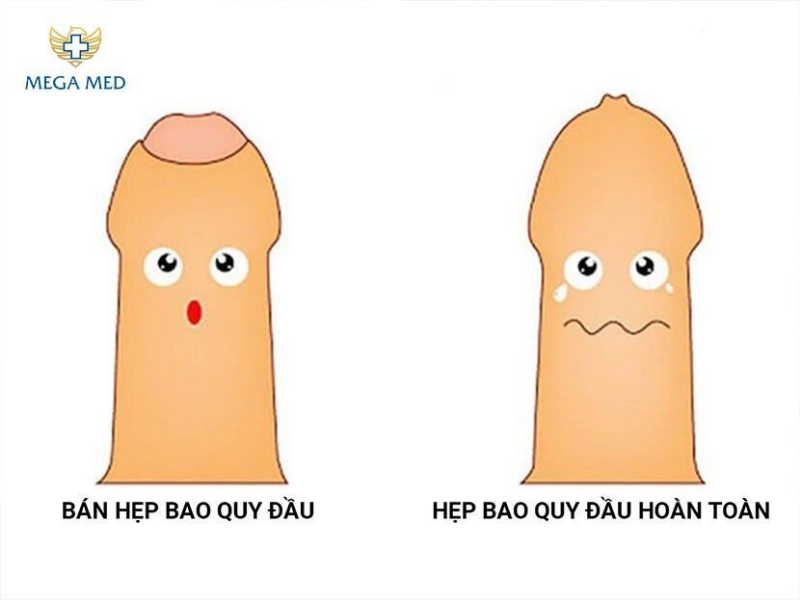 Hẹp bao quy đầu có nên cắt không? 